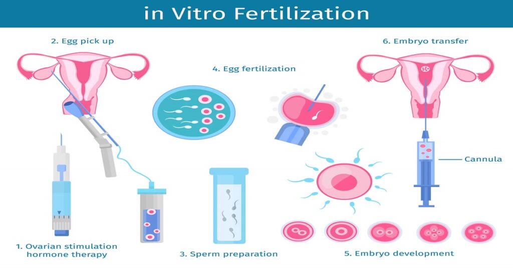 How Long Does It Take to Get Pregnant After IVF