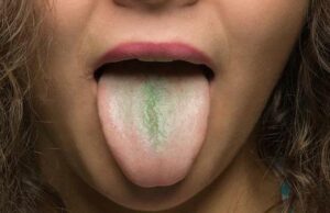 green tongue disease