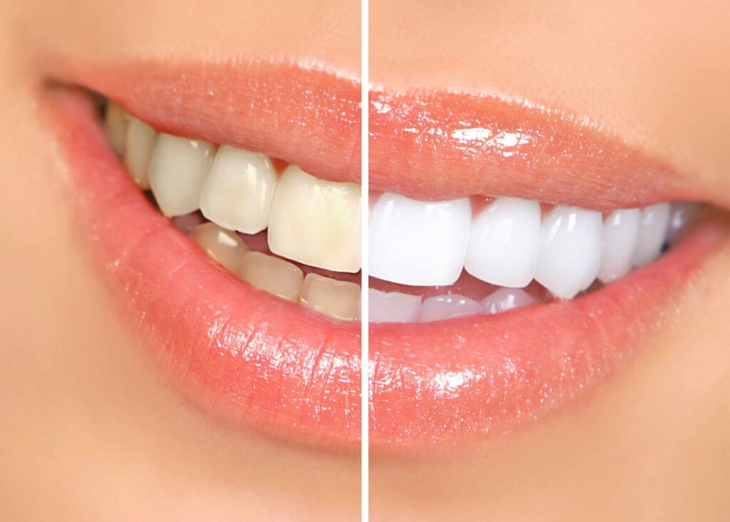 Teeth Whitening Nagpur