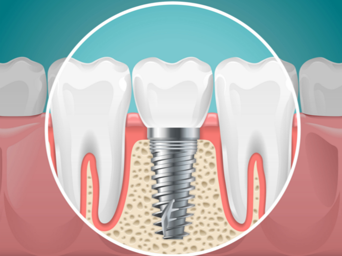 the science behind how dental bridges work