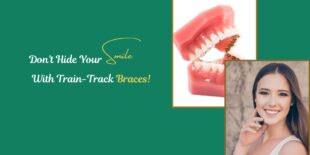 Dont Hide Your Smile With Train Track Braces