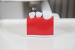 dental crowns crestview fl