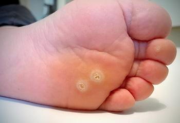 painful callus on foot