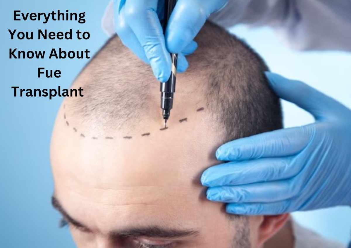 Everything You Need to Know About Fue Transplant