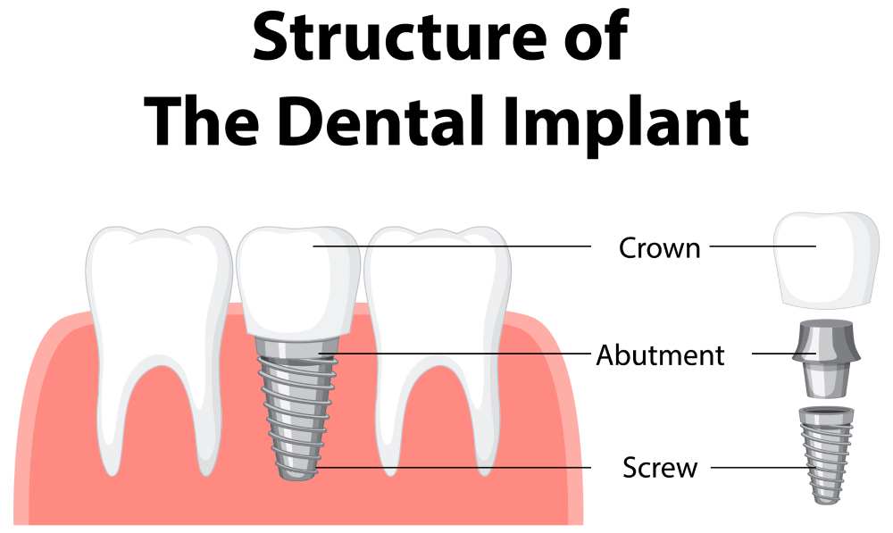 dental implant