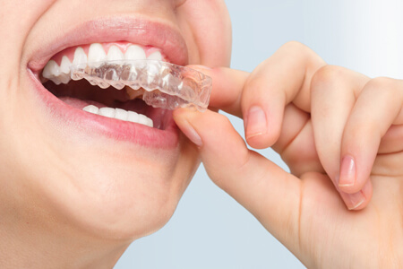 How Do Clear Aligners Work to Treat Crossbites Issues