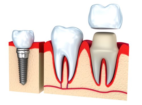 Top Aftercare Tips for Dental Crowns