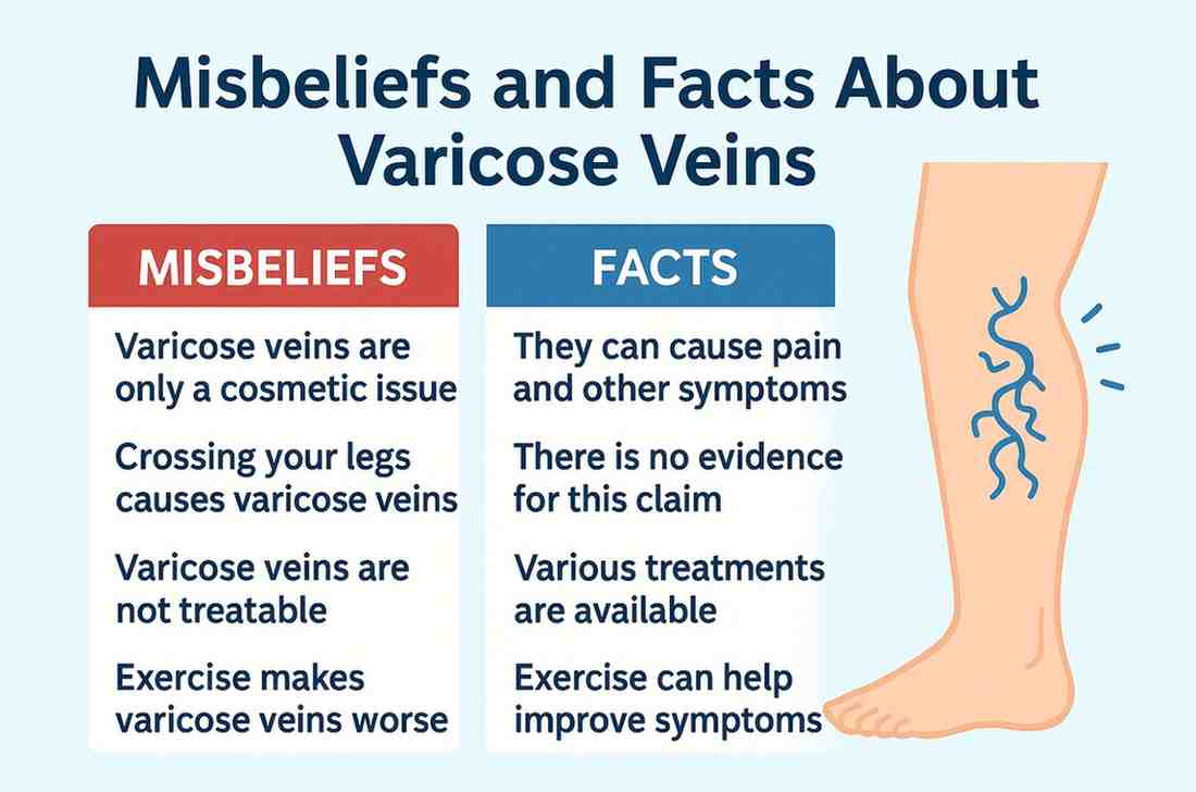Misbeliefs and Facts About Varicose Veins