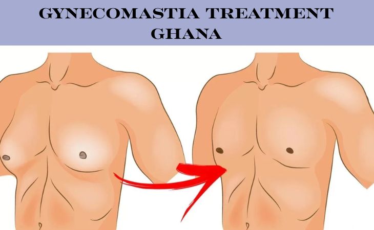Effective Gynecomastia treatment in Ghana 1 Gynecomastia treatment Ghana