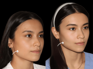 What Makes Sculptra Fillers Treatments in Dubai Unique?