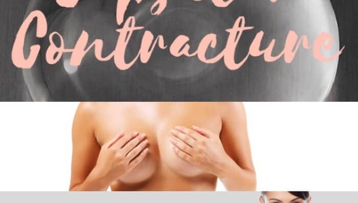 capsular contracture (1) (1)