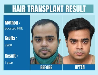 Hair Transplant Surgery Delhi: Achieve Natural Result