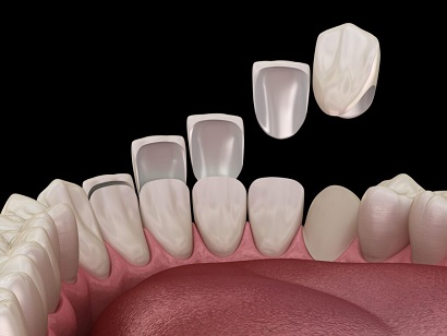 Dental Crown1