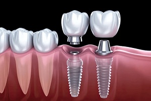 Dental Implants1