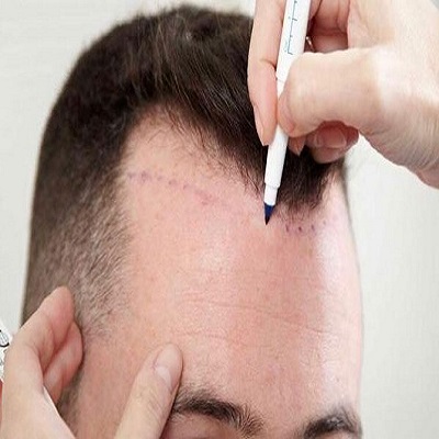 Regrow Your Hair Naturally with Islamabad Transplants