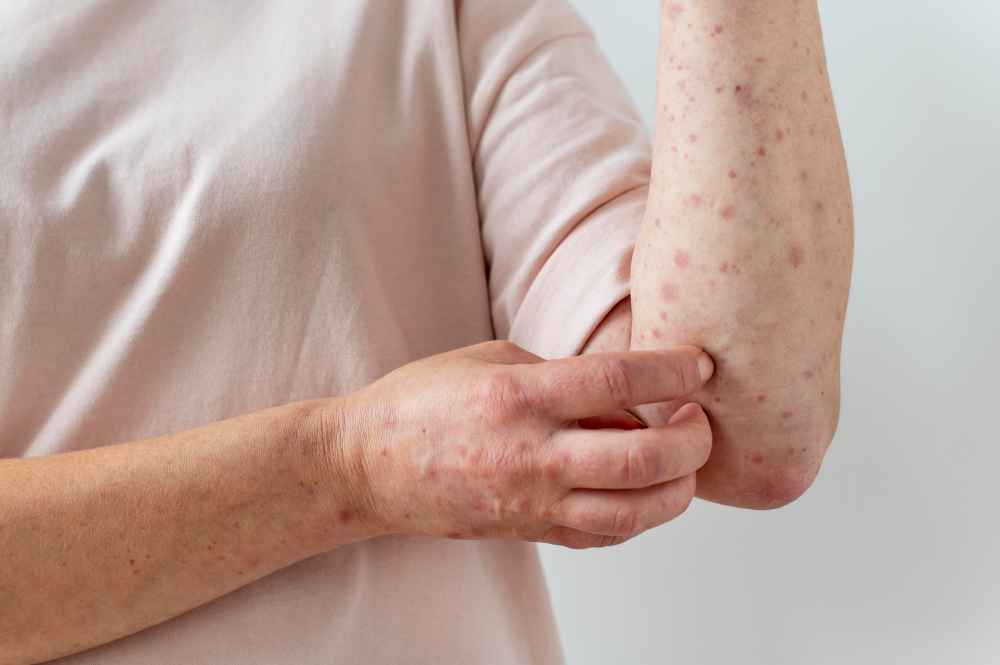 Lichen Nitidus: Symptoms, Causes, and Treatment