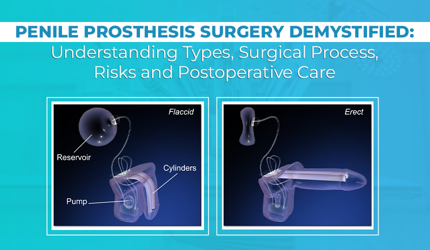 Penile Prosthesis Surgery In Bangalore | Worldofurology 1 Penile Prosthesis Surgery
