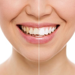 Teeth Whitening Dentist Campbelltown1