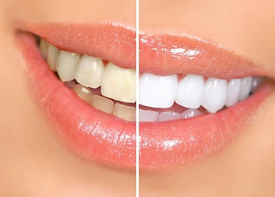 Teeth Whitening Mitcham1