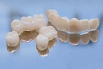 Restoring Strength and Appearance to Damaged Teeth
