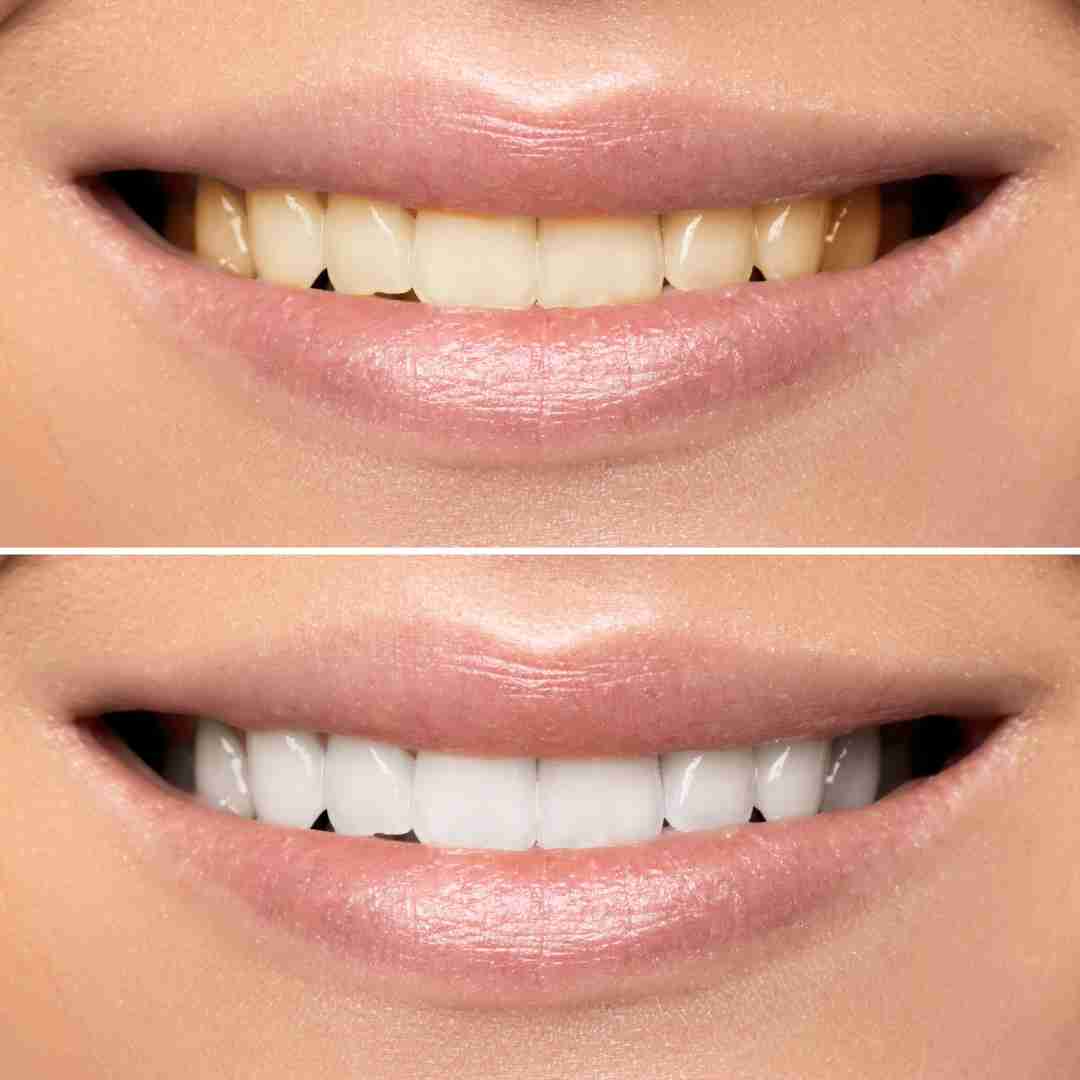 Why Teeth Get Stained and How Whitening Can Help?