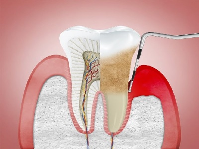 Periodontal Disease Treatment