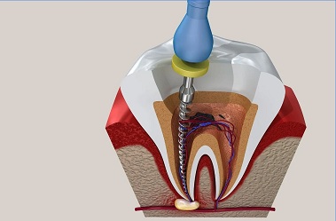 A Modern Look at Endodontic Therapy vs Tooth Extraction 1 Root Canal Campbelltown1