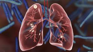 Can Lung Nodules Become Cancerous?