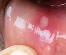 Aphthous ulcers, Causes, Symptoms & Treatments