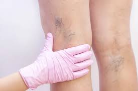 Finding Vascular Surgeon in Pune for Vein Problems