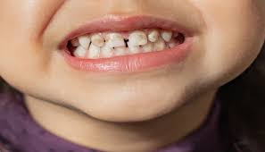 5 Things About Multivitamins Staining Teeth!