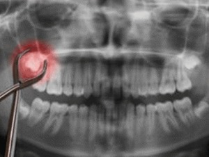 Professional Wisdom Tooth Extraction Services Near You 1 imgi 17 Wisdom Teeth Apple Tree Dental 300x226 1