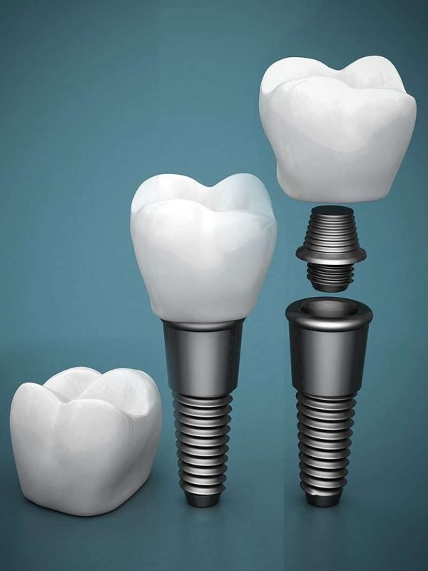 imgi 2 Implants pfx601mjgixaulyz5wd6ccqeldwwc2vx6wvvgcnr5s 1