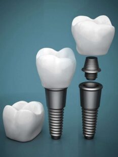imgi 2 Implants pfx601mjgixaulyz5wd6ccqeldwwc2vx6wvvgcnr5s