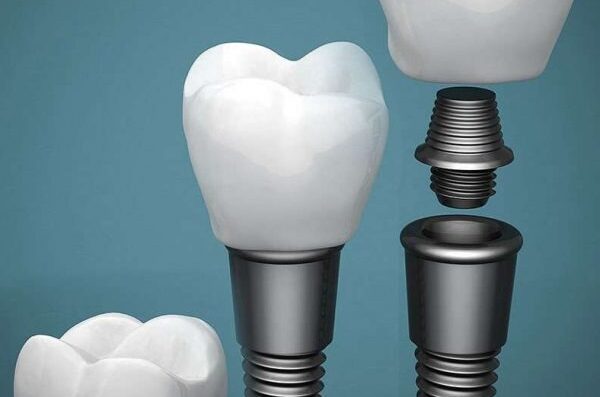 imgi 2 Implants pfx601mjgixaulyz5wd6ccqeldwwc2vx6wvvgcnr5s