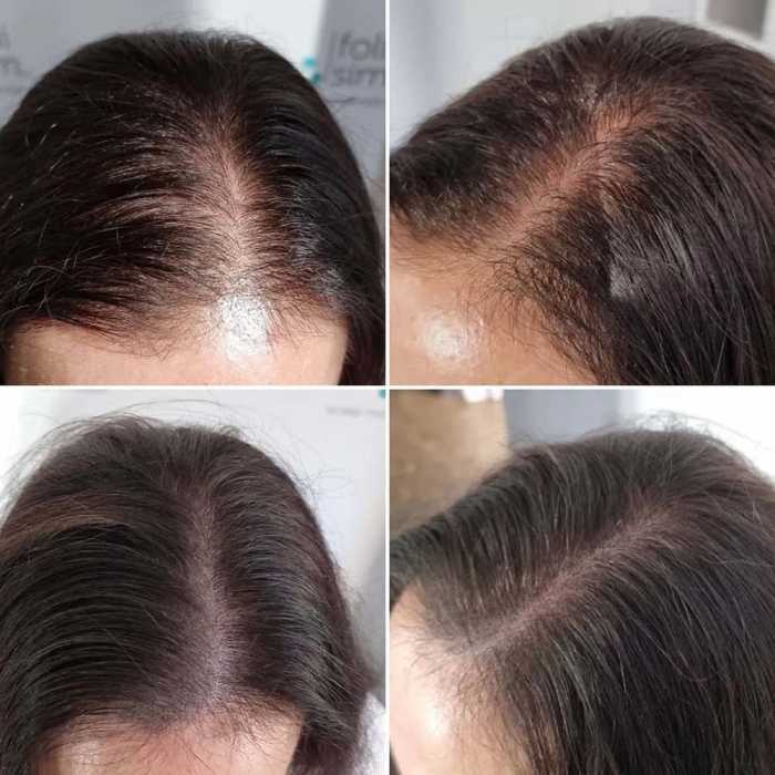 Scalp micropigmentation Cost Artful hair illusion begins here 1 scalp micropigmentation women 1 1