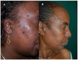 How to Reduce Melanin in Skin? 6 Effective Ways