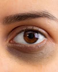Dark circles