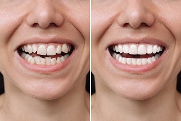 Enjoy a Discreet Smile: Invisible Aligners vs. Braces