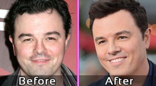 Seth MacFarlance Plastic Surgery Photos Before