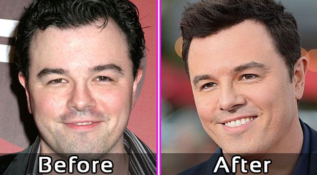 Seth MacFarlane Plastic Surgery: Separating Fact from Fiction 1 Seth MacFarlance Plastic Surgery Photos Before