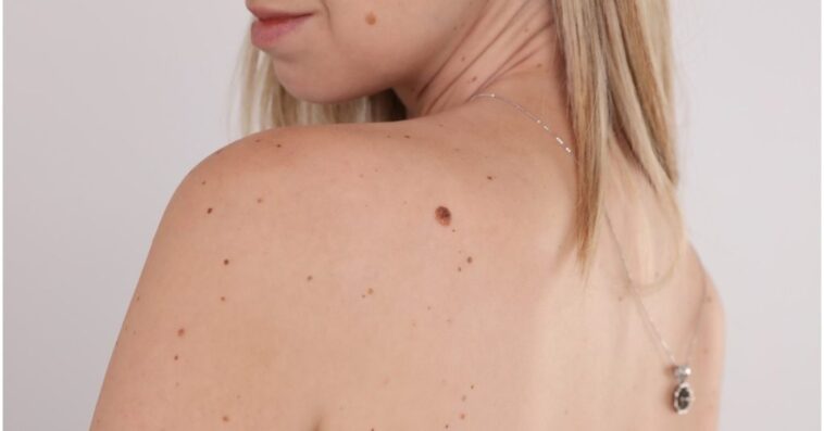 skin tags removal leeds