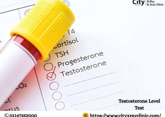 Testosterone Level Test