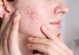 Say Goodbye to Acne Scars – Expert Treatment in Trivandrum! 1 download 9