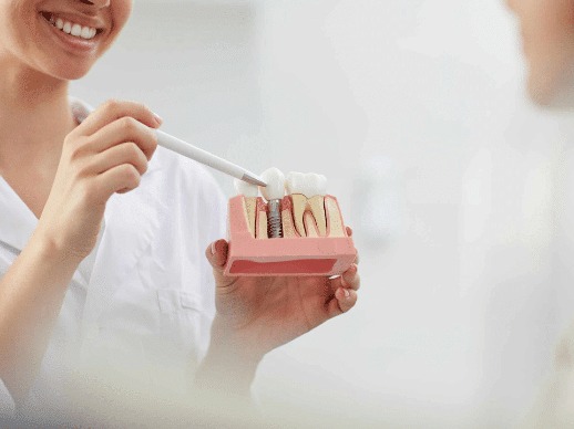 Long-Lasting Dental Implants in London, Ontario 1 imgi 2 Dental Implants apple Tree Dental 1