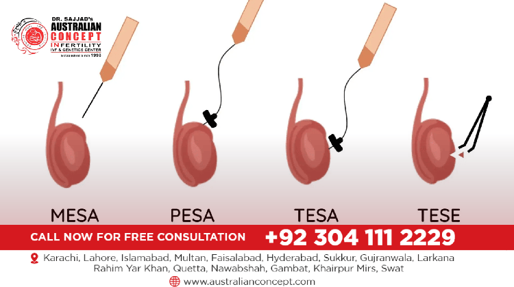 Which Clinic in Lahore Offers Micro TESE Surgery