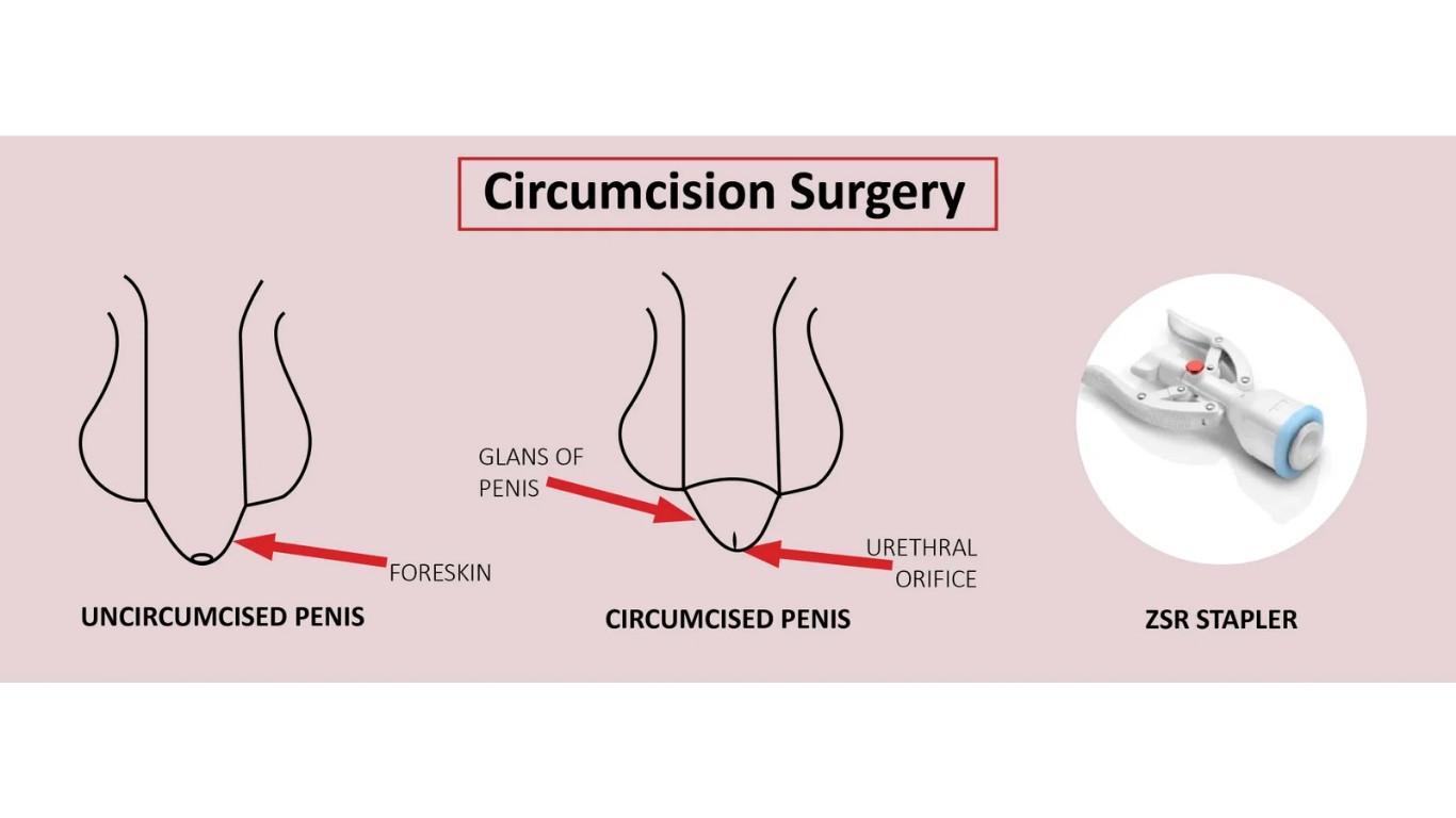 Circumcision Surgery  Benefits, Risks, and Recovery
