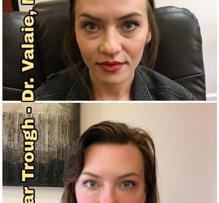 BAGS UNDER EYES 14