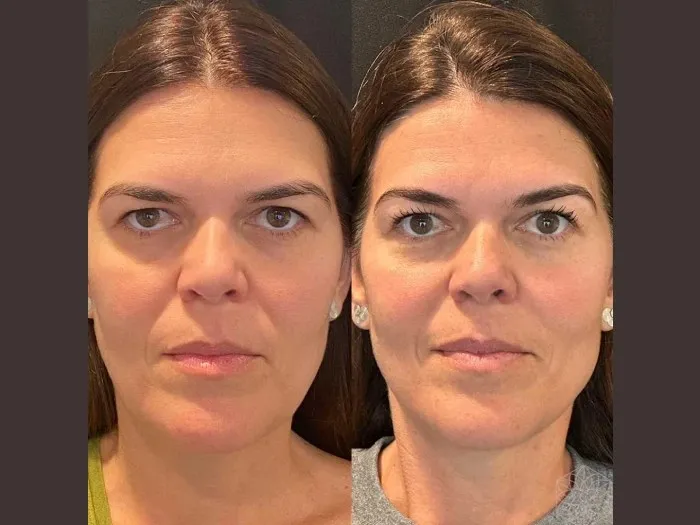 Thread Lift at Best Aesthetic Clinics in Dubai