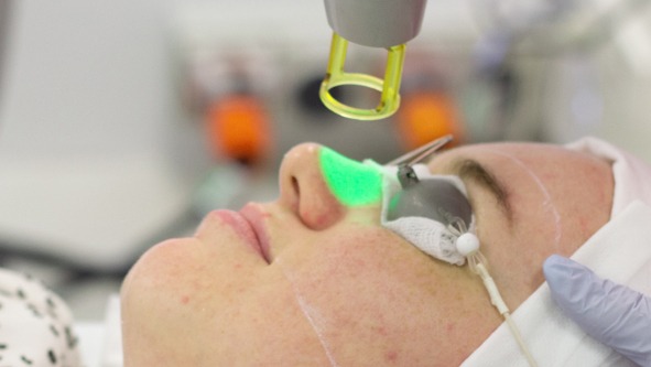Laser Pigmentation Removal Clermont 1 Laser redness CSC 1